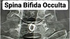 Spina bifida occulta : Mildest... - Ashoka Radiology centre