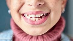 Dentistry, process and girl with braces, teeth for before and after with oral care cosmetics and smile. Closeup, kid and person with mouth for dental hygiene, treatment and results with procedure