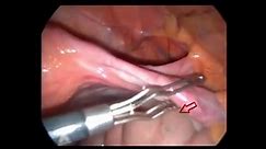 Laparoskopic intestinal injury (Glutaraldehyde induced Bowel I...