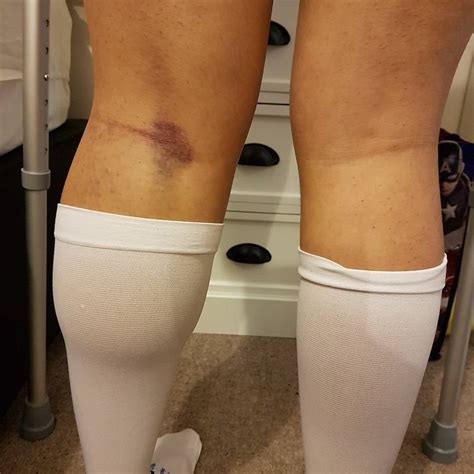 Foot And Ankle Swelling After Knee Replacement Surgery - Printables Templates Free