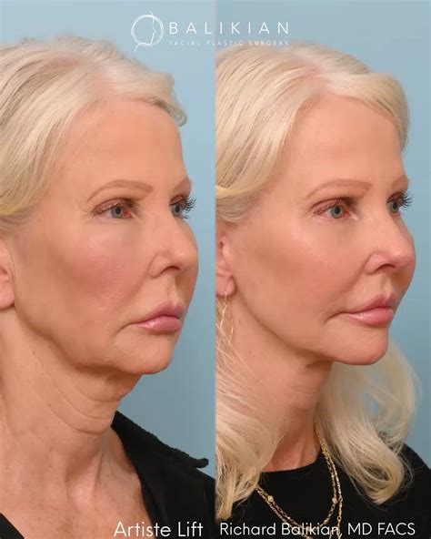 How Facelift Incisions Are Designed for Healing & Natural Results