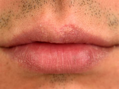 How to Get Rid of Fordyce Spots ⋆ ctf.bnsf.com