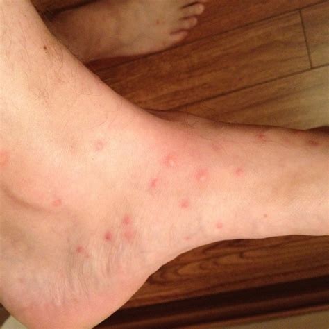 Identifying Insect Bites: 17 Pictures of Common Bug Bites