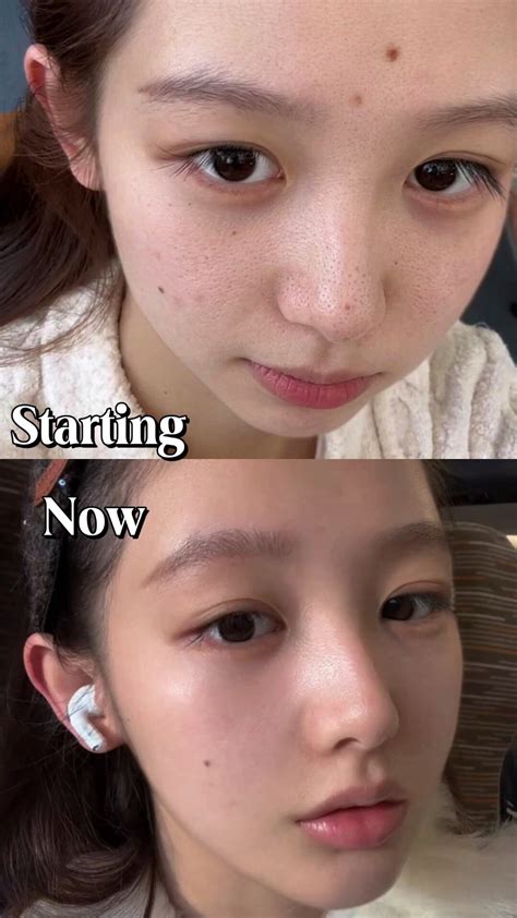 I’ve put in lots of efforts to fix my large pores.since coming to Kore... | TikTok
