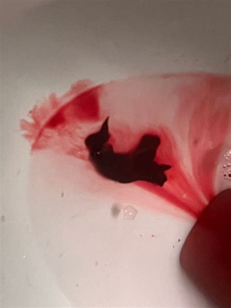 *blood clot photo* Have you had bleeding during pregnancy without a loss? | BabyCenter
