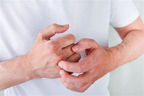 How Do You Know if You Need Systemic Medications for Psoriasis? - Dermatology and Laser Centre