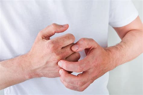 How Do You Know if You Need Systemic Medications for Psoriasis? - Golden State Dermatology