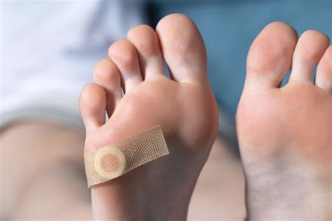 How to Prevent Plantar Warts From Spreading