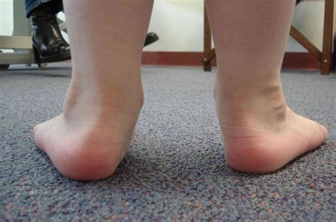 Kids Orthotics for Flat Feet – Podiatrist Advice for Parents