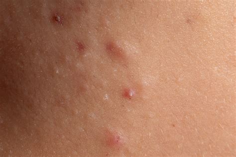 Bumps That Look Like Pimples: Acne or Something Else? | Cedars-Sinai | Cedars-Sinai