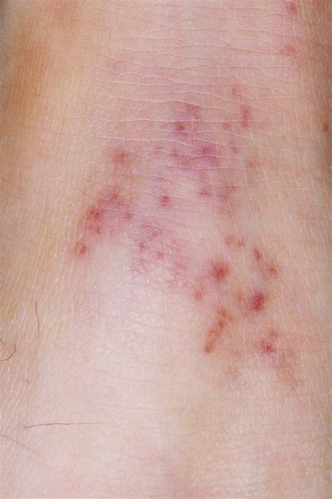 Why Do I Have a Rash on My Neck?