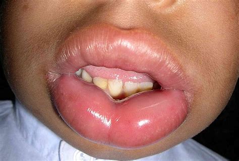 Hereditary Angioedema Swelling Symptoms: Skin, GI, More