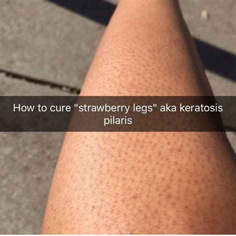 How to get rid of strawberry legs 🍓 Swipe 👉🏽 | Strawberry legs, Body ...