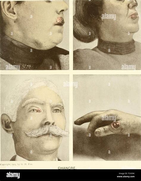 Engravings of different human body parts infected with chancre ...