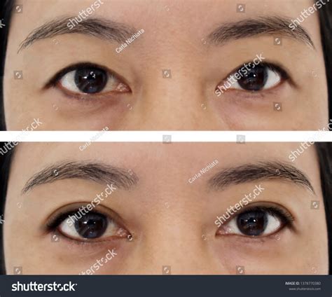 Single Eyelid Vs Double Eyelid