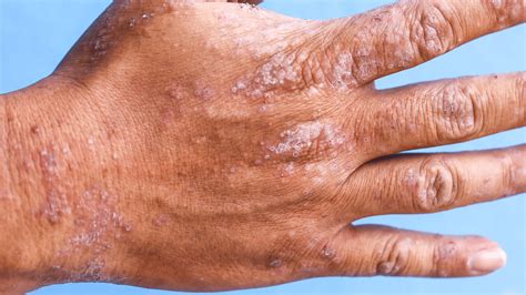 Types of Eczema: Contact Dermatitis | Gladskin