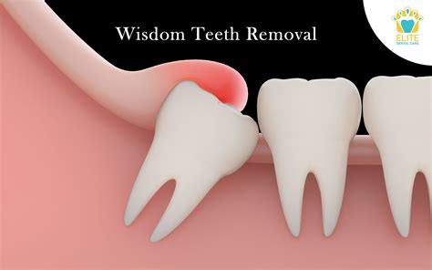 WISDOM TEETH REMOVAL - ELITE DENTAL CARE, TRACY - Elite Dental Care