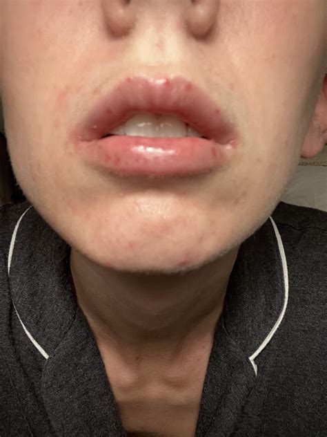 Small Red Spots on Lips : r/DermatologyQuestions