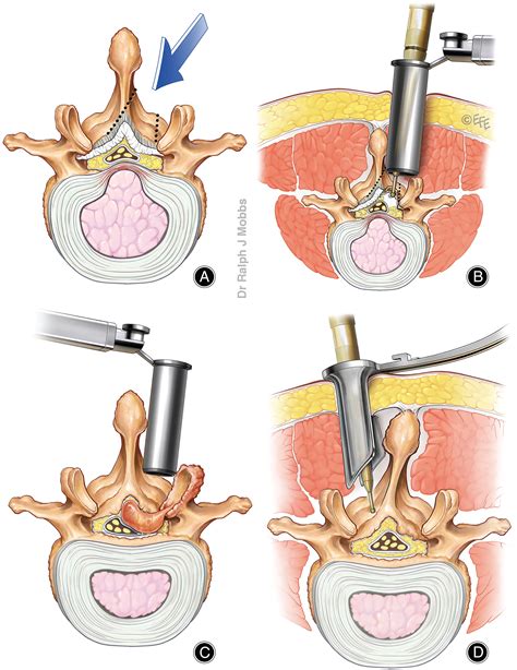 Foraminotomy Vs Laminectomy