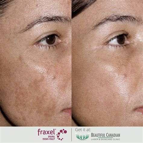 Vancouver Hyperpigmentation Treatments with Lasers & More | Surrey