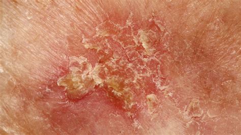 Squamous Cell Skin Cancer Diagnosis | Wellesley Dermatology