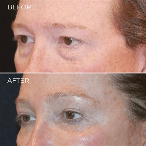 How Much Does Eyelid Surgery Cost?