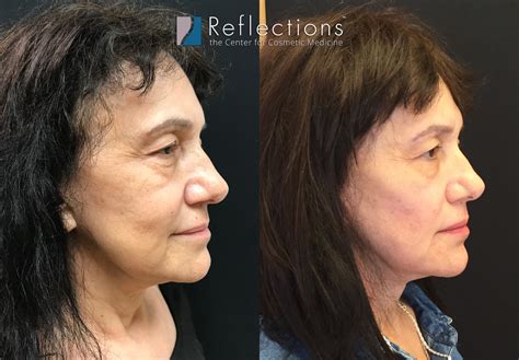 Non Medical Facelift Before And After Images And Results
