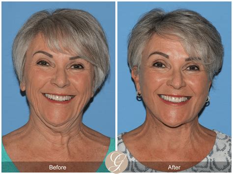 Deep Plane Facelift and Deep Plane NeckLift Case 1 Before After Photos Orange County