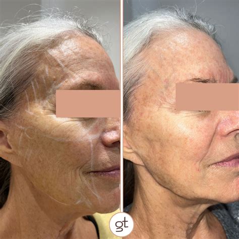 Before and After Gallery Dermal Fillers - Stunning Transformations
