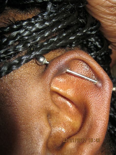 Aspirin paste shrinks keloids and bumps due to piercings.... I sure ...