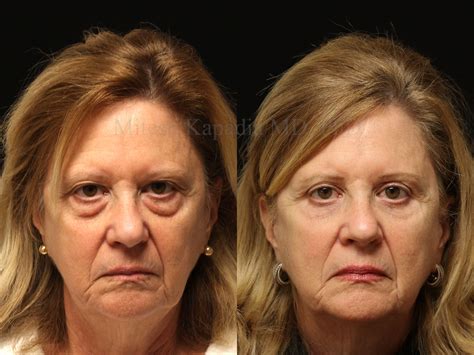 Before and seven months after upper and lower blepharoplasty surgery with CO2 laser resurfacing ...