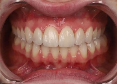 Gum Abscess Popped? Thinking of Popping It Yourself?