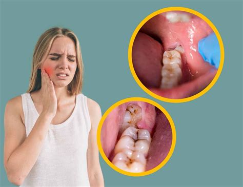 Wisdom Tooth Pain Explained: Common Causes, Symptoms, and Treatment Option - crystalline Dental