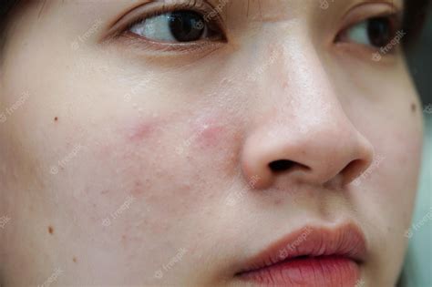 Grano de acné y cicatriz en la piel trastornos de la cara de las glándulas sebáceas adolescente ...