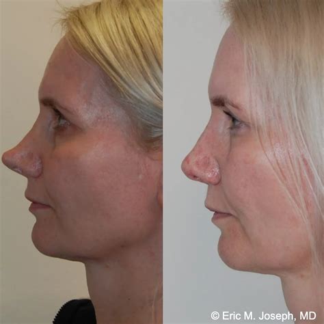 Eric M. Joseph, MD | Revision Rhinoplasty Before & After: With Previous ...