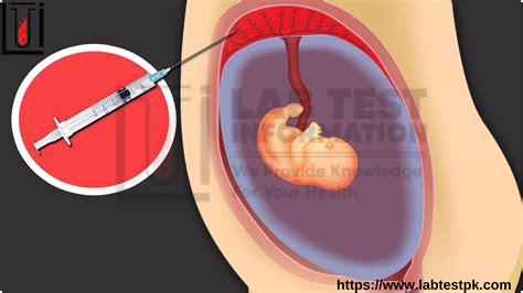 Chorionic Villus Sampling