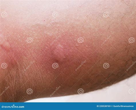 A Bruise that Has Been Stung by an Insect Stock Image - Image of care ...
