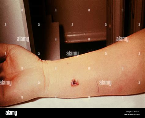 Anthrax, skin of right forearm, 7th day. 27 year old white female with cutaneous anthrax on ...
