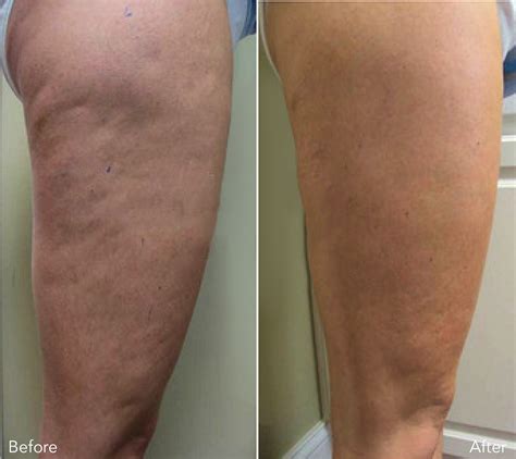 Cellulite Before And After Weight Loss