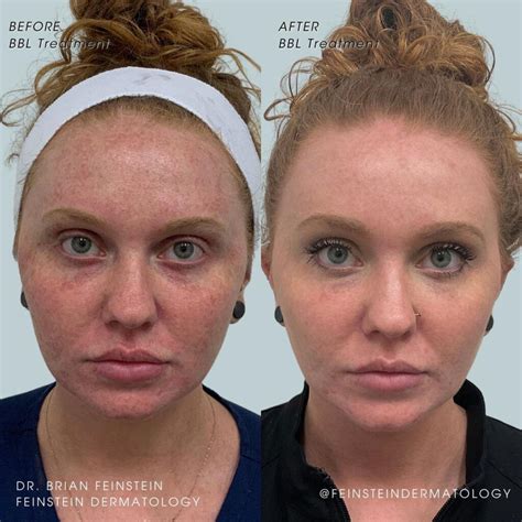 5 Dermatologist-Approved Treatments For Sun-Damaged Skin | Feinstein Dermatology