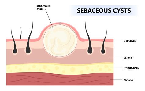 Sebaceous Cyst Treatment in Delhi | Plusify Healthcare