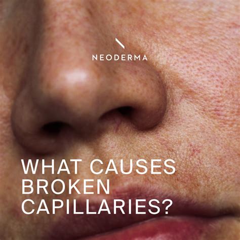 What Happens When Your Capillaries Burst at Reynaldo Leahy blog