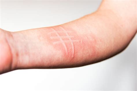 Dermographic Urticaria Tattoos Dermatographia: Facts About A Common