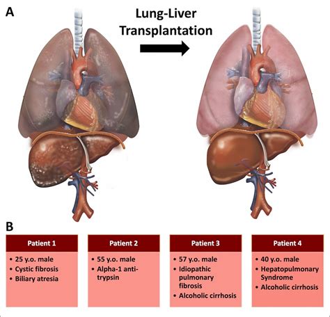 WTSA - Single-Center Experience of Lung-Liver Transplantation: Indications and Outcomes