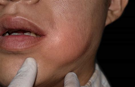 ¿Qué es un absceso cutáneo? - Tratamiento para eliminarlo