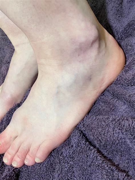 Why are my feet turning purple and fingernails turning white? : r/medical