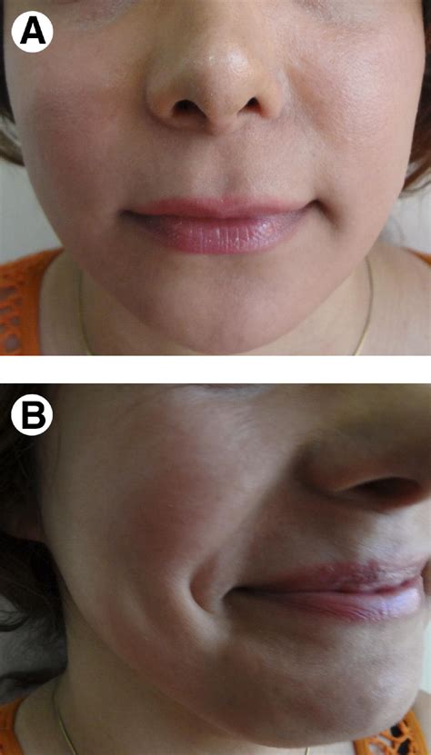 Dimple Creation Surgery Technique: A Review of the Literature and ...