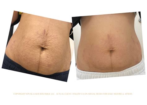 Stretch Marks And Laser Treatment