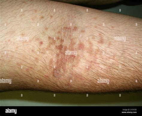 Confluent and reticulated papillomatosis on the arm of a 16 year old ...