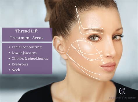 What Is A Cosmetic Thread Lift at Ruben Ramos blog